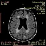 ДИАГНОСТИКА И ЛЕЧЕНИЕ РАССЕЯННОГО СКЛЕРОЗА В КЫРГЫЗСКОЙ РЕСПУБЛИКЕ - КУНДУЗ КАРБОЗОВА АССИСТЕНТ КАФЕДРЫ НЕВРОЛОГИИ И КЛИНИЧЕСКОЙ ГЕНЕТИКИ КГМА ...