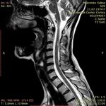ДИАГНОСТИКА И ЛЕЧЕНИЕ РАССЕЯННОГО СКЛЕРОЗА В КЫРГЫЗСКОЙ РЕСПУБЛИКЕ - КУНДУЗ КАРБОЗОВА АССИСТЕНТ КАФЕДРЫ НЕВРОЛОГИИ И КЛИНИЧЕСКОЙ ГЕНЕТИКИ КГМА ...