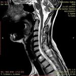 ДИАГНОСТИКА И ЛЕЧЕНИЕ РАССЕЯННОГО СКЛЕРОЗА В КЫРГЫЗСКОЙ РЕСПУБЛИКЕ - КУНДУЗ КАРБОЗОВА АССИСТЕНТ КАФЕДРЫ НЕВРОЛОГИИ И КЛИНИЧЕСКОЙ ГЕНЕТИКИ КГМА ...