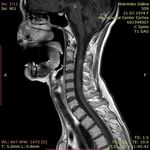 ДИАГНОСТИКА И ЛЕЧЕНИЕ РАССЕЯННОГО СКЛЕРОЗА В КЫРГЫЗСКОЙ РЕСПУБЛИКЕ - КУНДУЗ КАРБОЗОВА АССИСТЕНТ КАФЕДРЫ НЕВРОЛОГИИ И КЛИНИЧЕСКОЙ ГЕНЕТИКИ КГМА ...