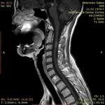 ДИАГНОСТИКА И ЛЕЧЕНИЕ РАССЕЯННОГО СКЛЕРОЗА В КЫРГЫЗСКОЙ РЕСПУБЛИКЕ - КУНДУЗ КАРБОЗОВА АССИСТЕНТ КАФЕДРЫ НЕВРОЛОГИИ И КЛИНИЧЕСКОЙ ГЕНЕТИКИ КГМА ...