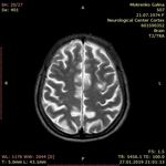 ДИАГНОСТИКА И ЛЕЧЕНИЕ РАССЕЯННОГО СКЛЕРОЗА В КЫРГЫЗСКОЙ РЕСПУБЛИКЕ - КУНДУЗ КАРБОЗОВА АССИСТЕНТ КАФЕДРЫ НЕВРОЛОГИИ И КЛИНИЧЕСКОЙ ГЕНЕТИКИ КГМА ...